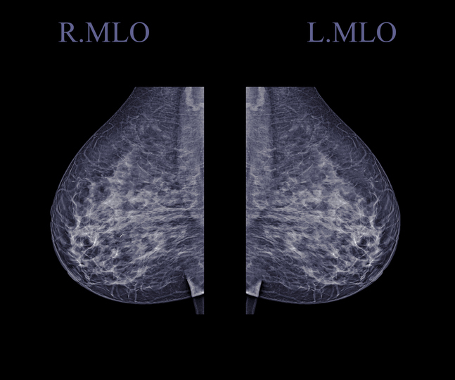 X-ray Digital Mammogram