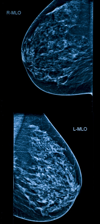 Mammogram scan