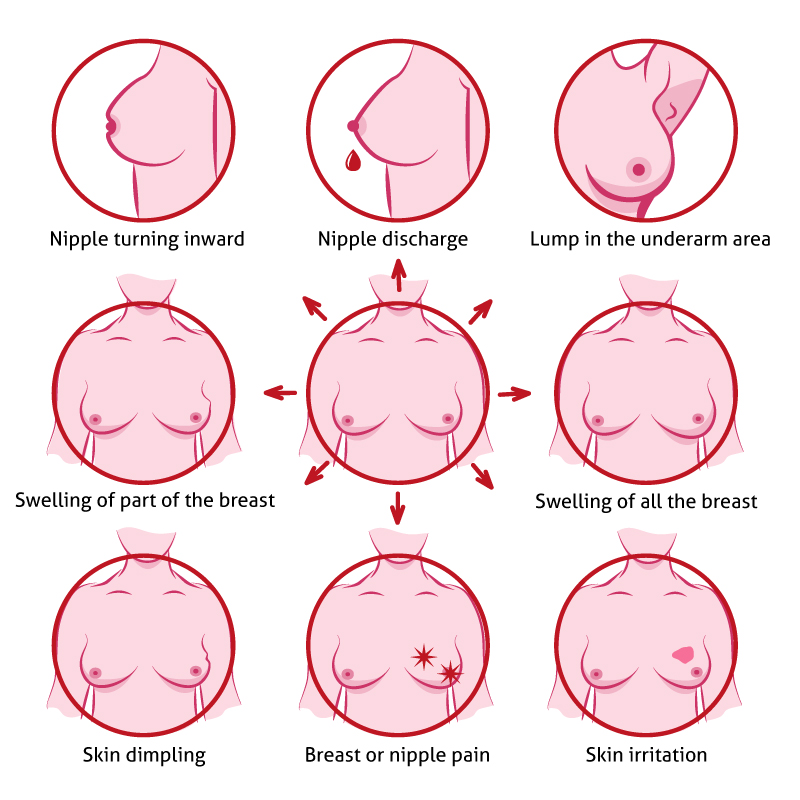 Symptoms of breast cancer