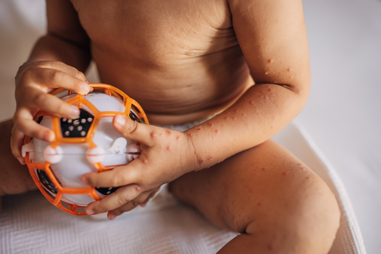 Photo of child's torso and arms covered in rash and blisters.