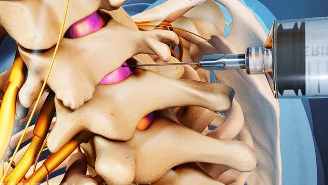 Pain in the neck? Cervical spine epidural may help