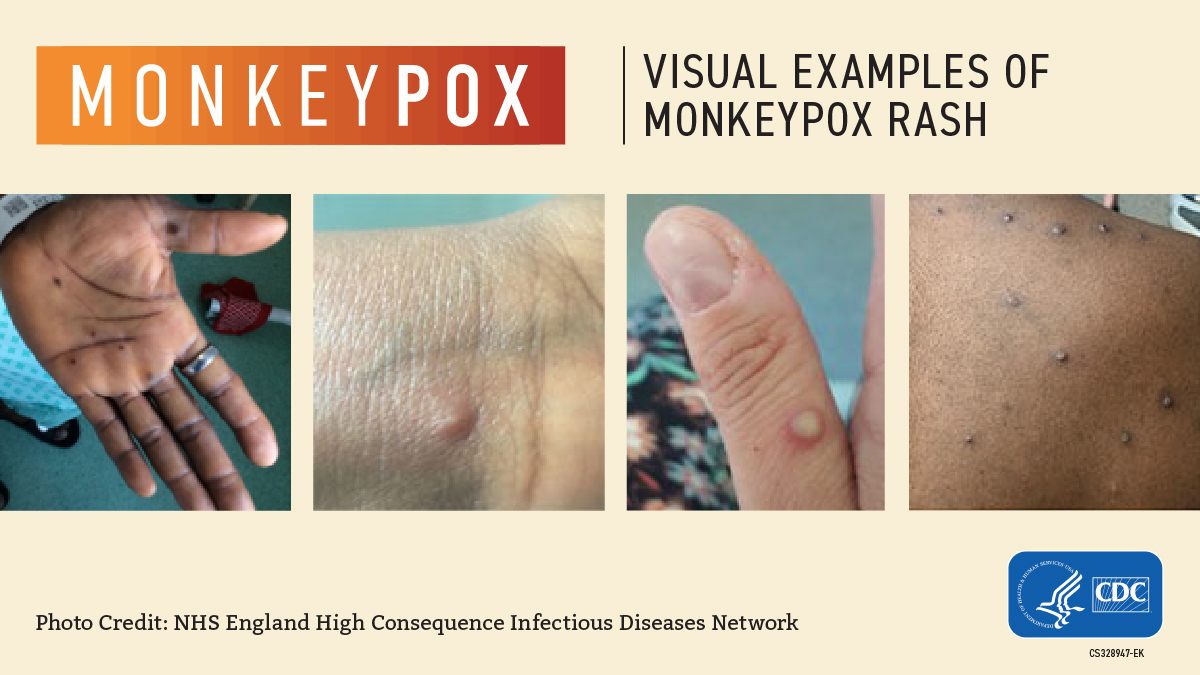 Monkeypox symptoms, prevention, and vaccine