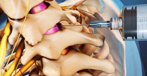 Pain in the neck? Cervical spine epidural may help