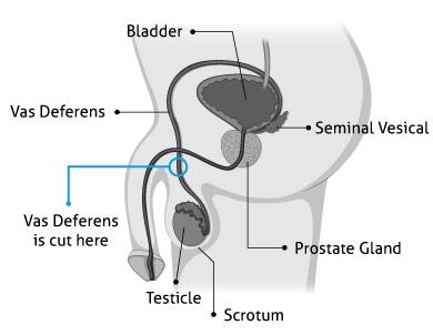 Vasectomy Diagram