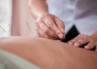 Acupuncture treatment